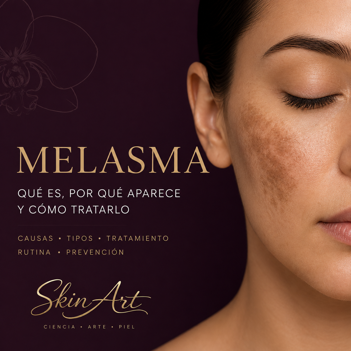 Melasma: qué es, por qué aparece y cómo tratarlo